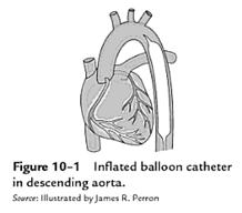 IABP Intra-Aortic Balloon
